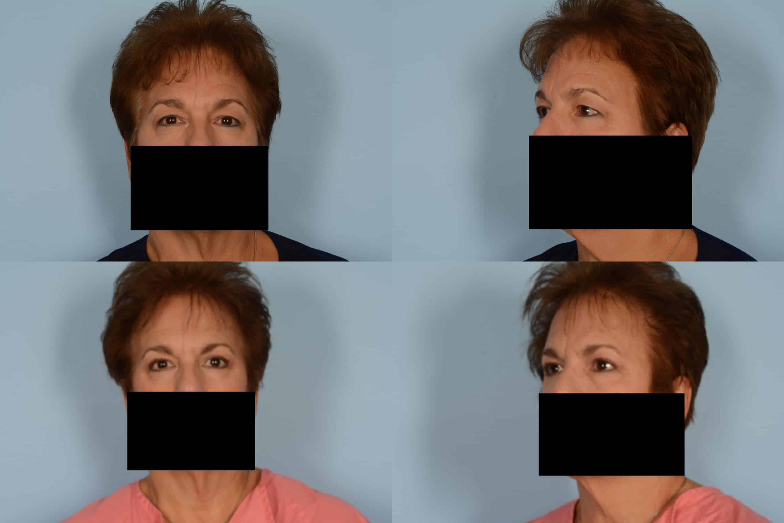 Blepharoplasty Case# 1142 Combined Image