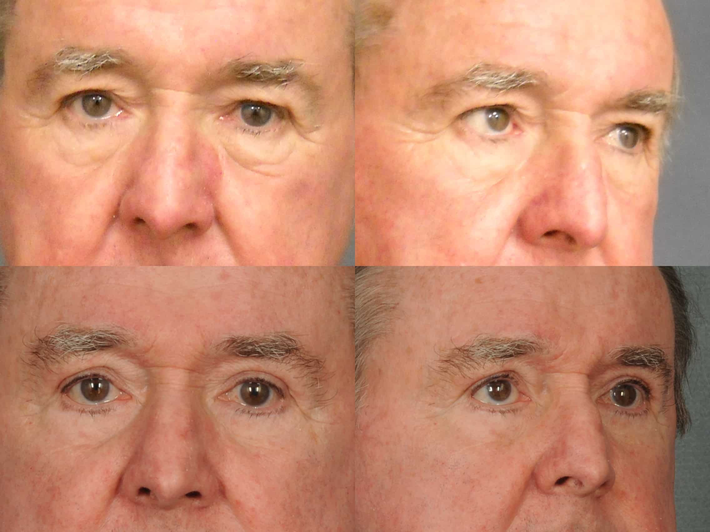 Blepharoplasty Case# 371 Combined Image