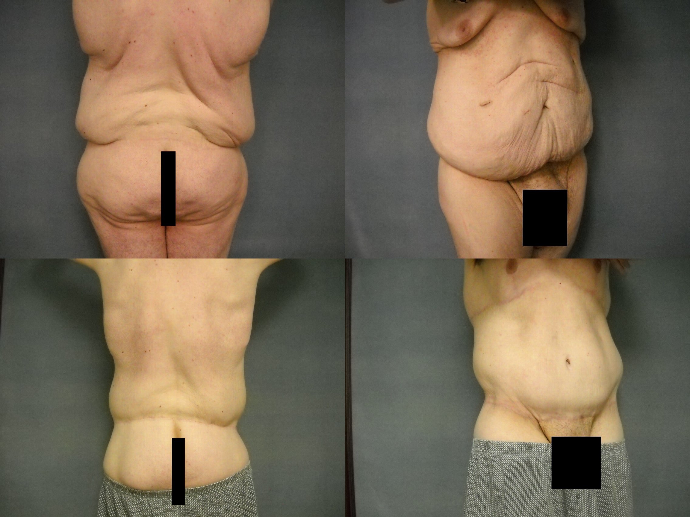 Tummy Tuck Case# 255 Combined Image
