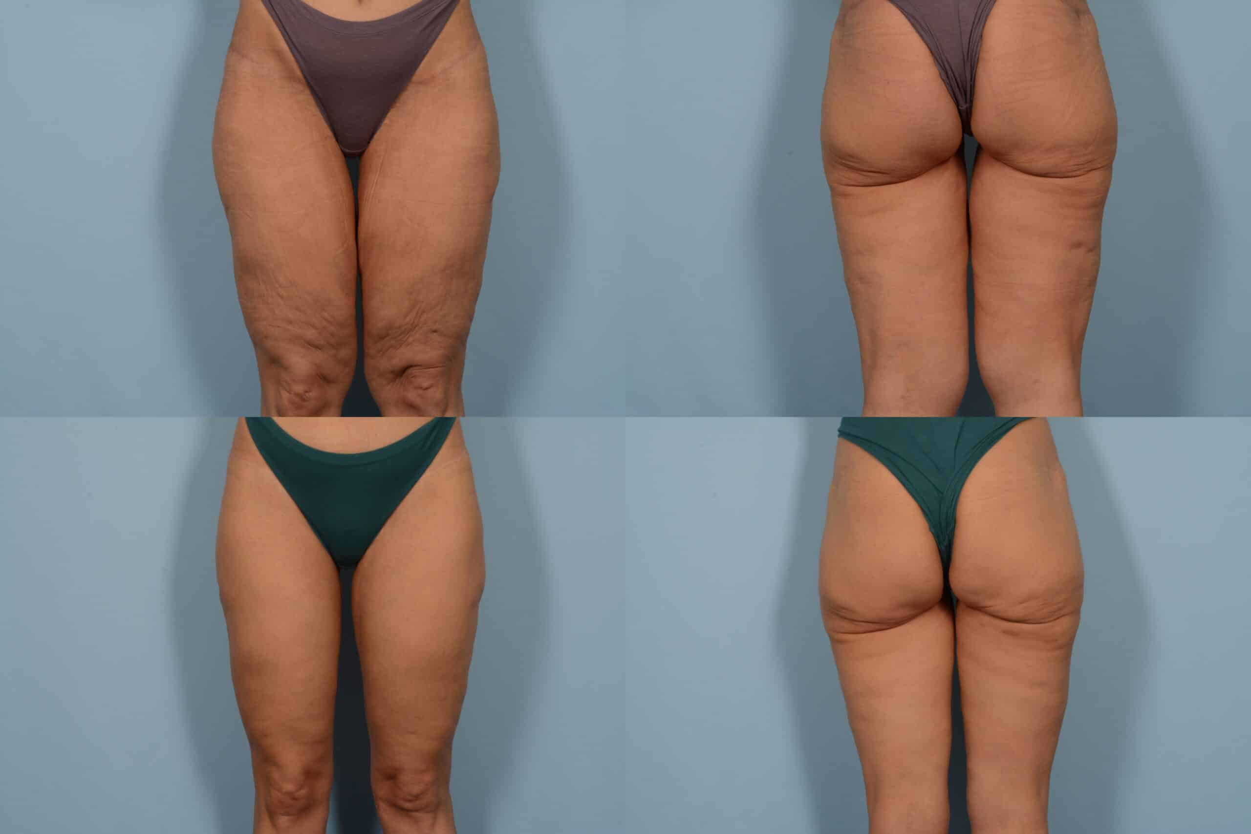 Thigh Lift Case# 1137 Combined Image