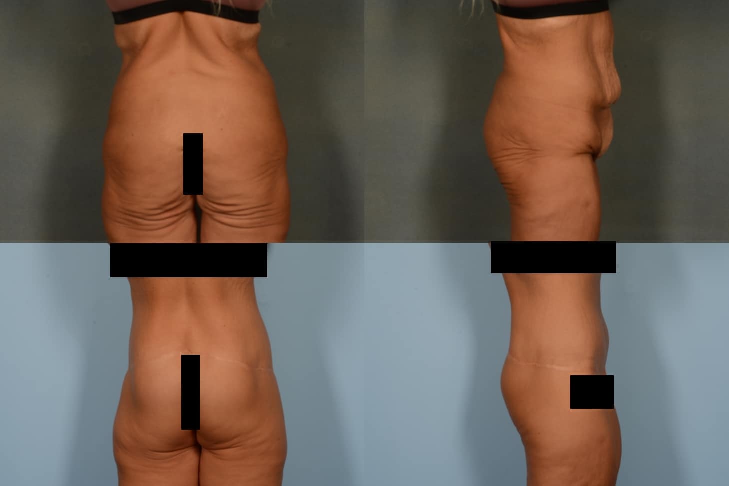 Back Lift Case# 1131 Combined Image