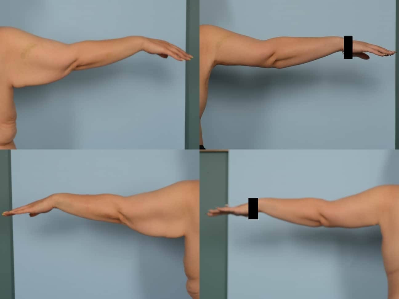Arm Lift Case 1180 Combined Image