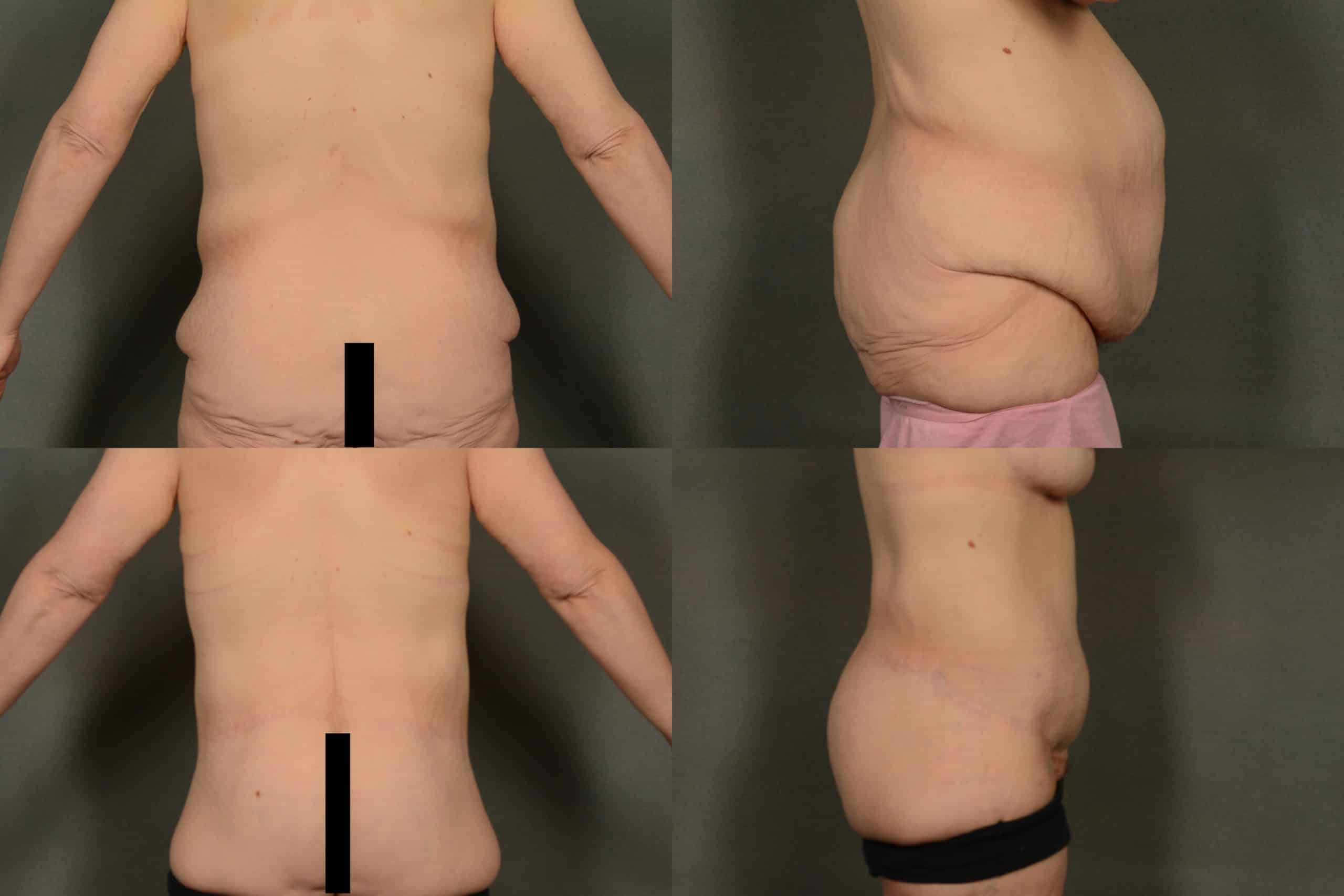Back Lift Case# 964 Combined Image