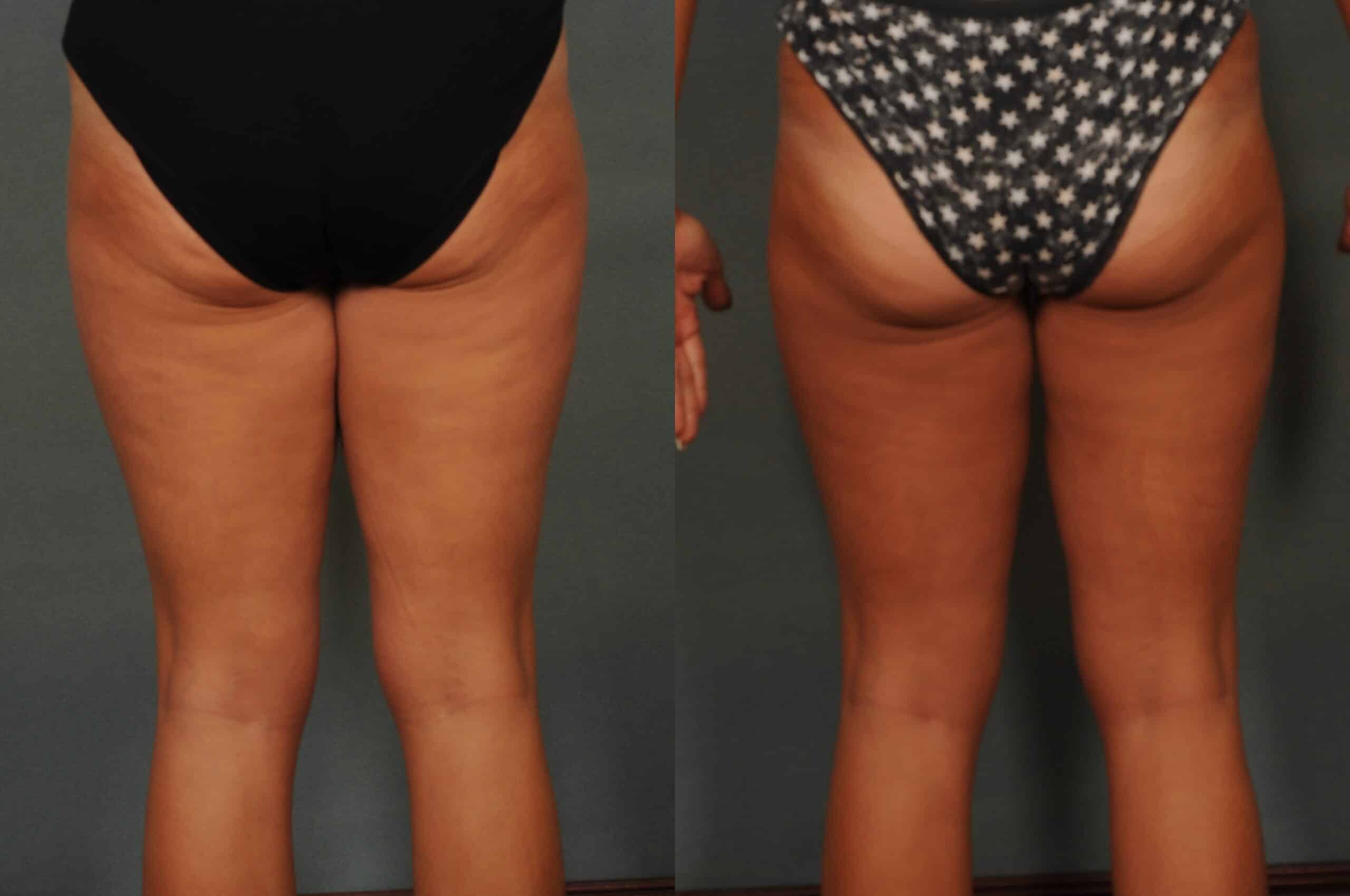Liposuction Case# 1071 Combined Image