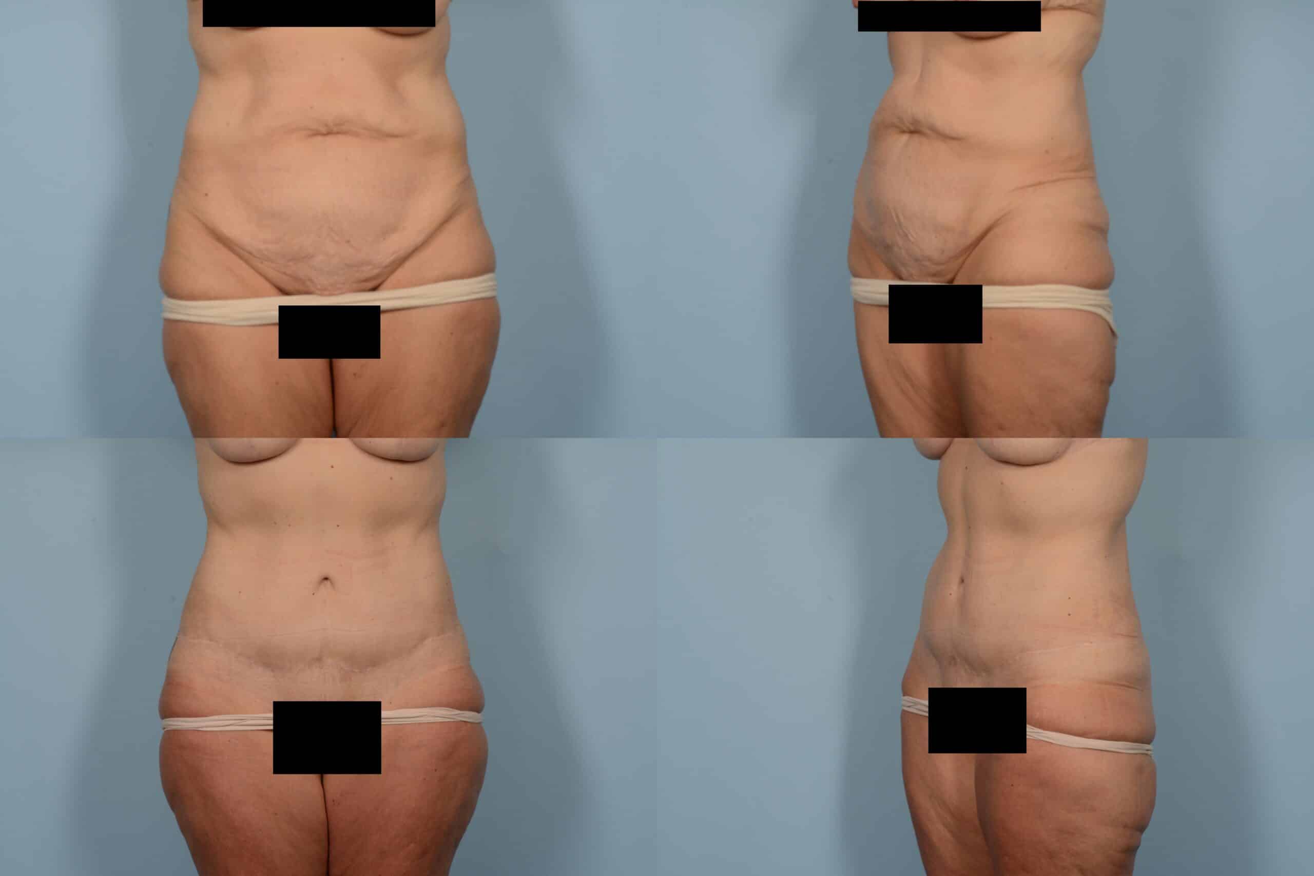 Tummy Tuck Case# 1149 Combined Image