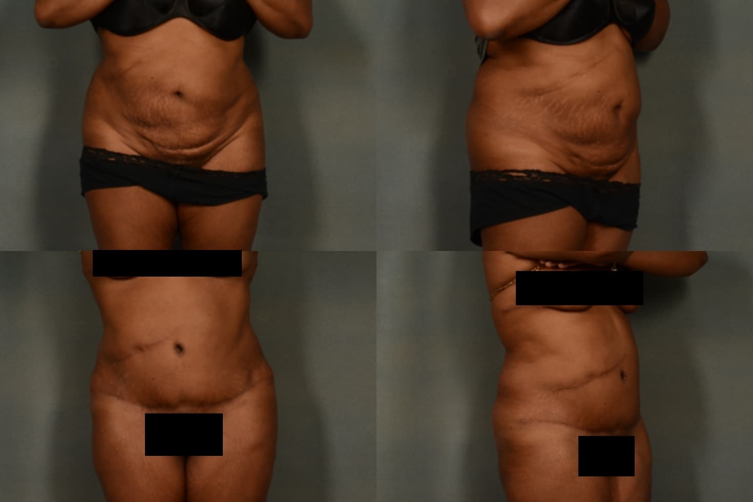 Tummy Tuck Case# 960 Combined Image