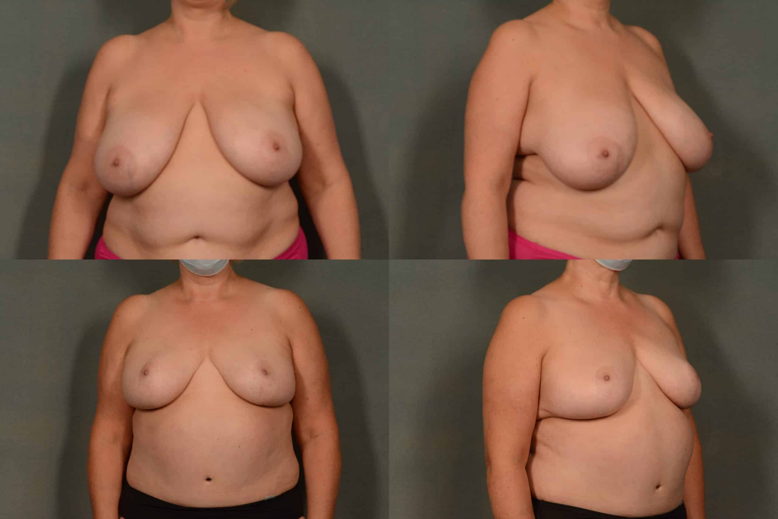 Breast Reduction Case# 999 Combined Image