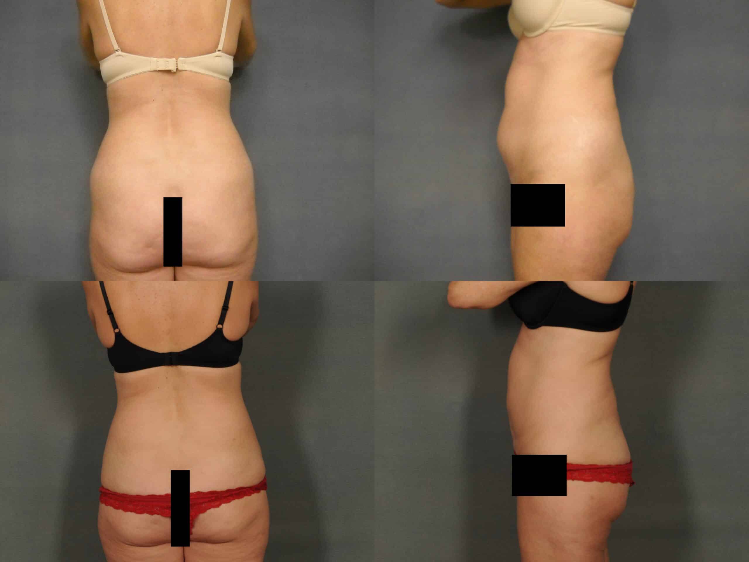 Liposuction Case# 1075 Combined Image