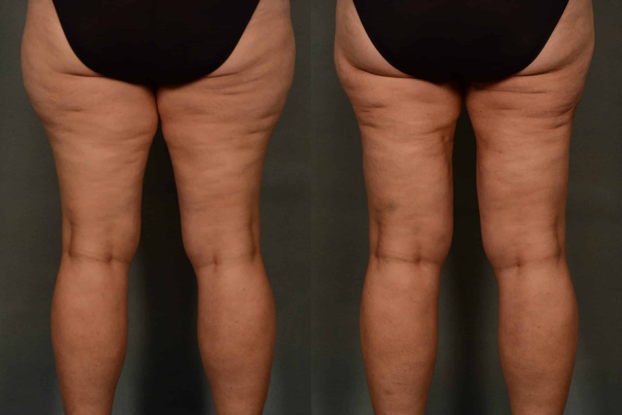 Liposuction Case# 1078 Combined Image