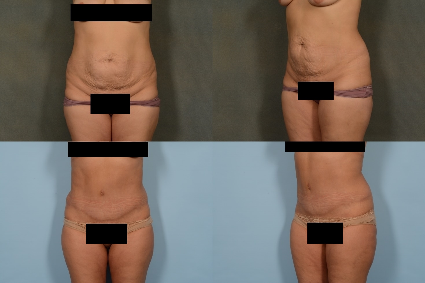 Tummy Tuck Case# 1043 Combined Image