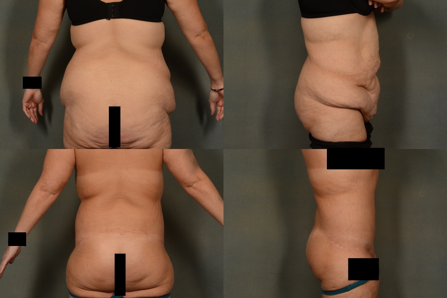 Back Lift Case# 1004 Combined Image