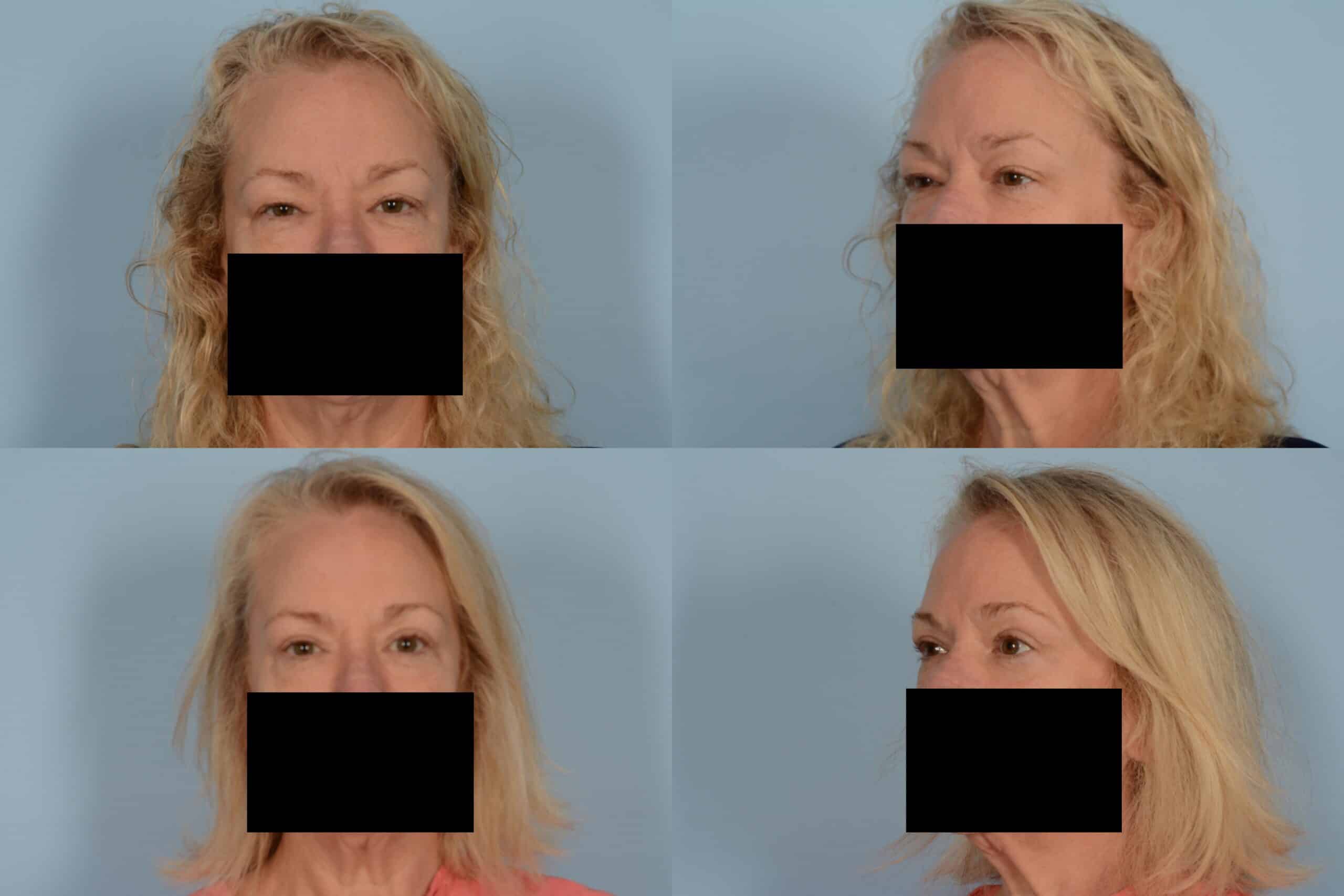 Blepharoplasty Case# 1110 Combined Image