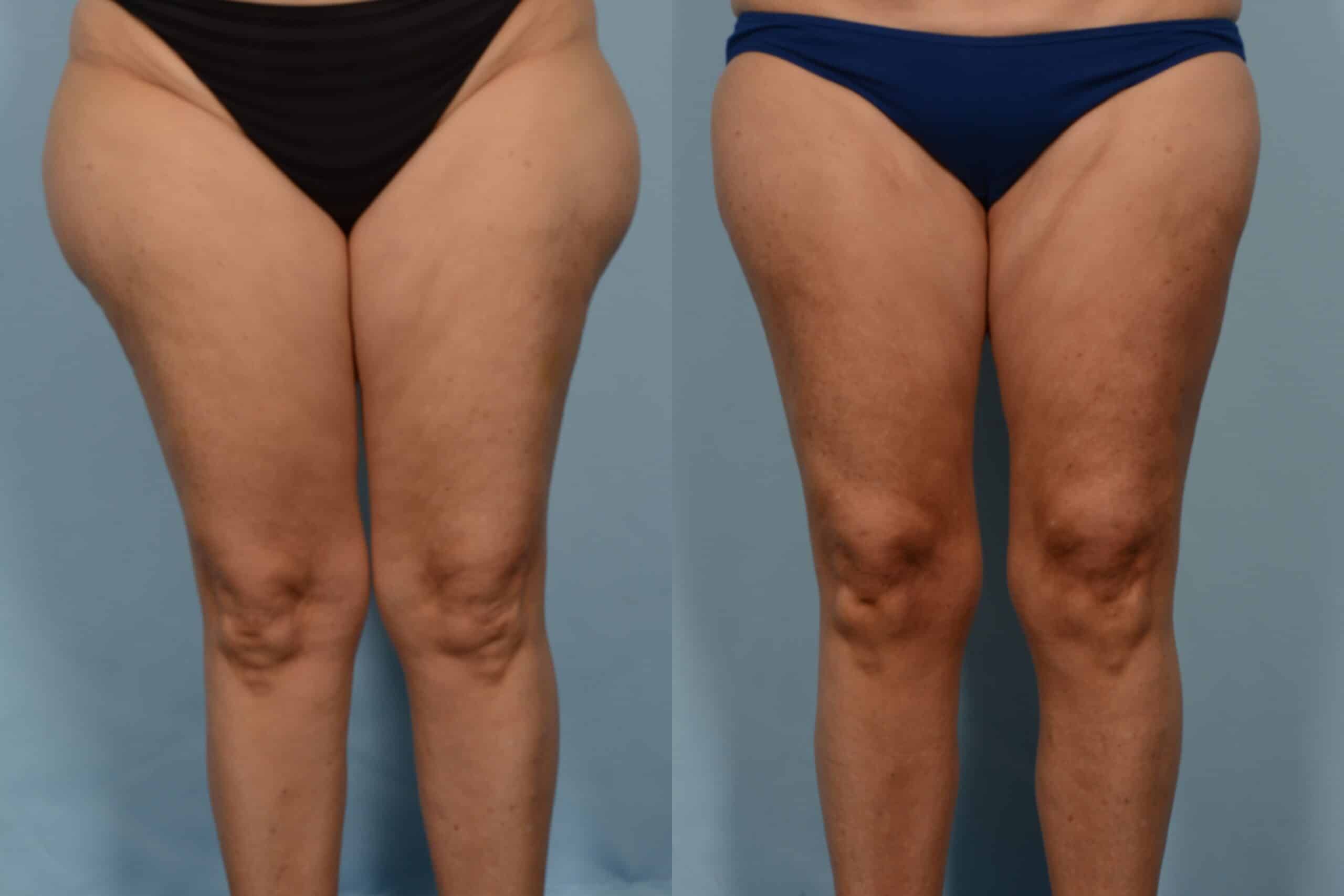 Liposuction Case# 1157 Combined Image