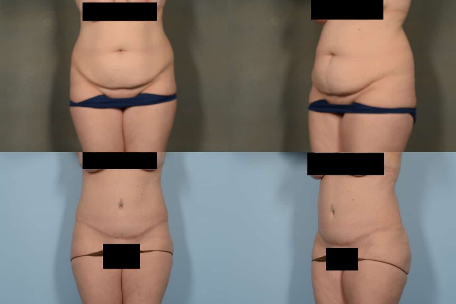 Tummy Tuck Case# 1083 Combined Image