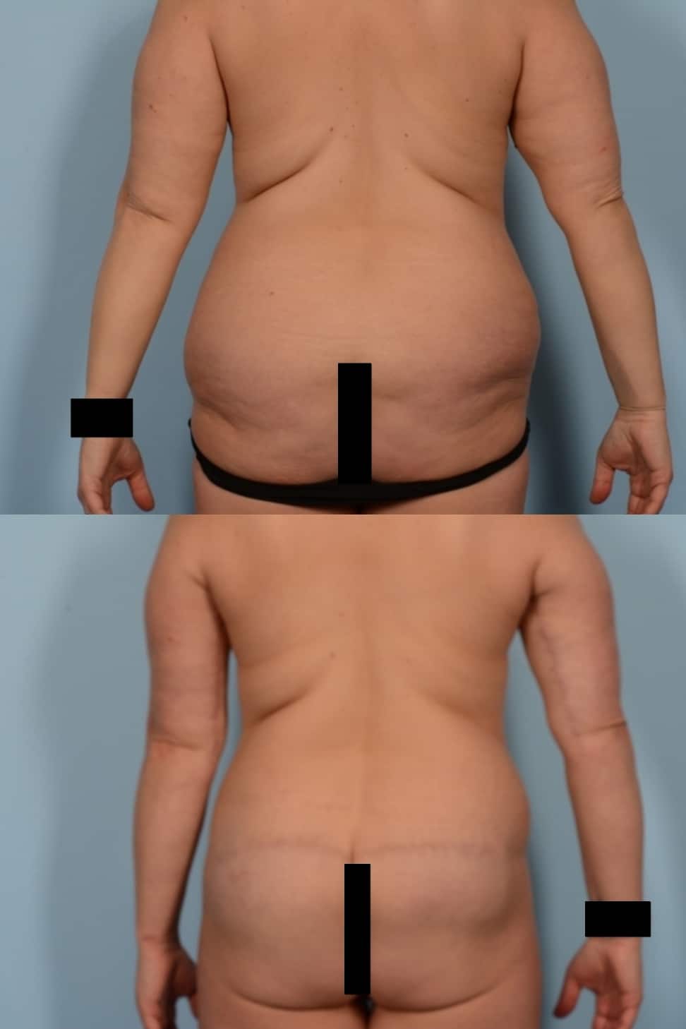 Back Lift Case# 1152 Combined Image