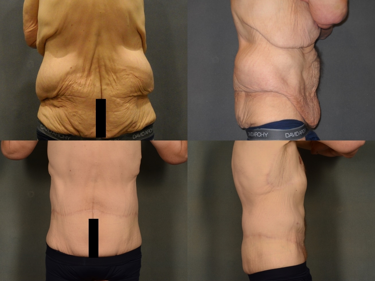 Back Lift Case # 984 Combined Image