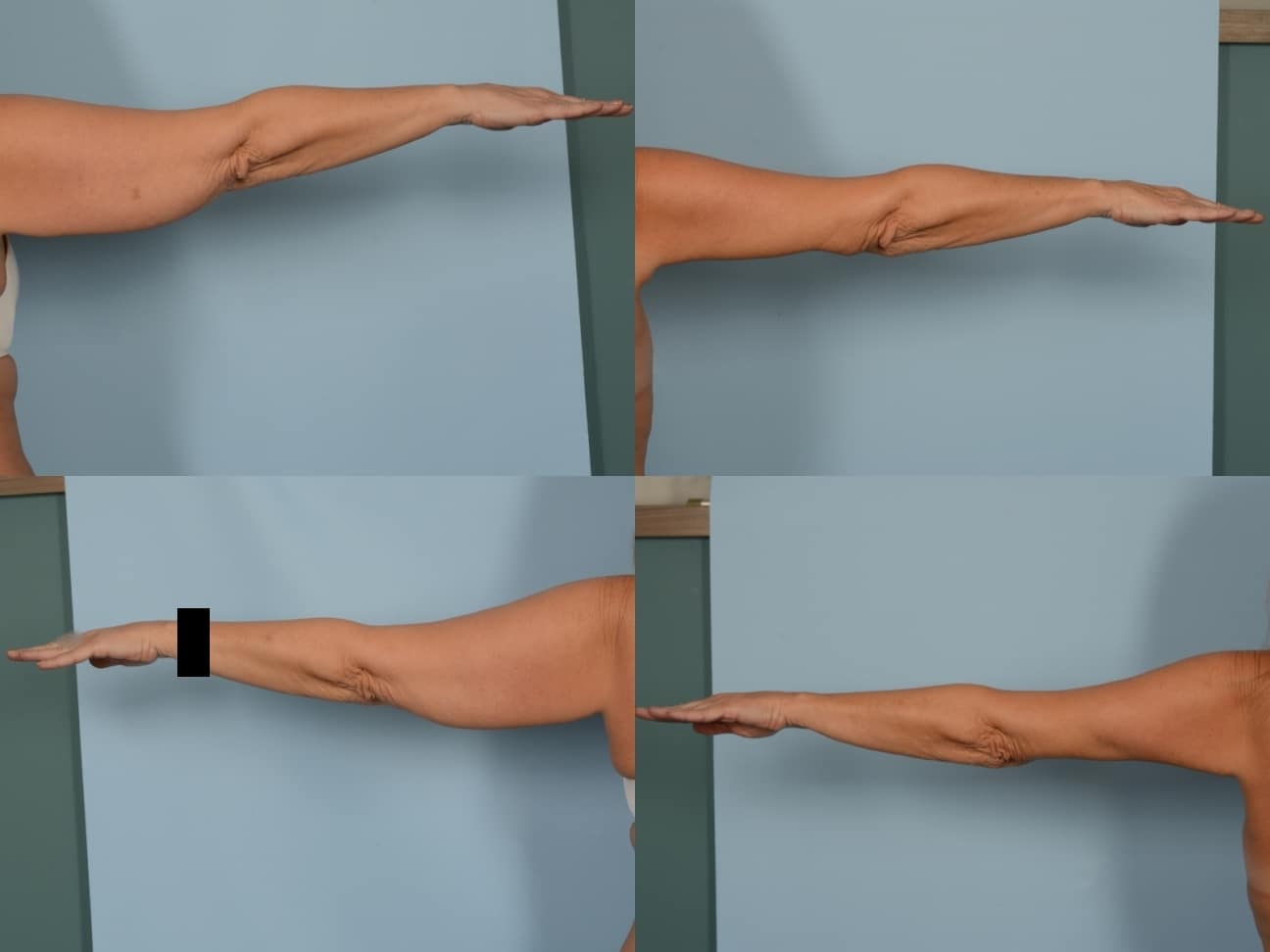 Arm Lift Case# 1178 Combined Image