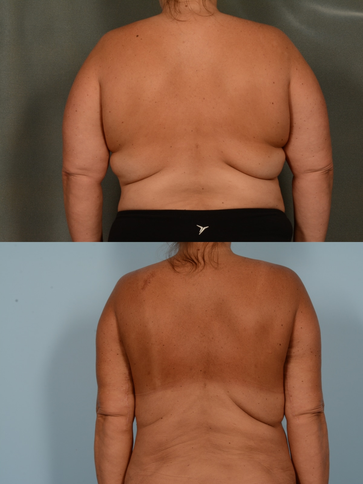 Liposuction Case# 1161 Combined Image