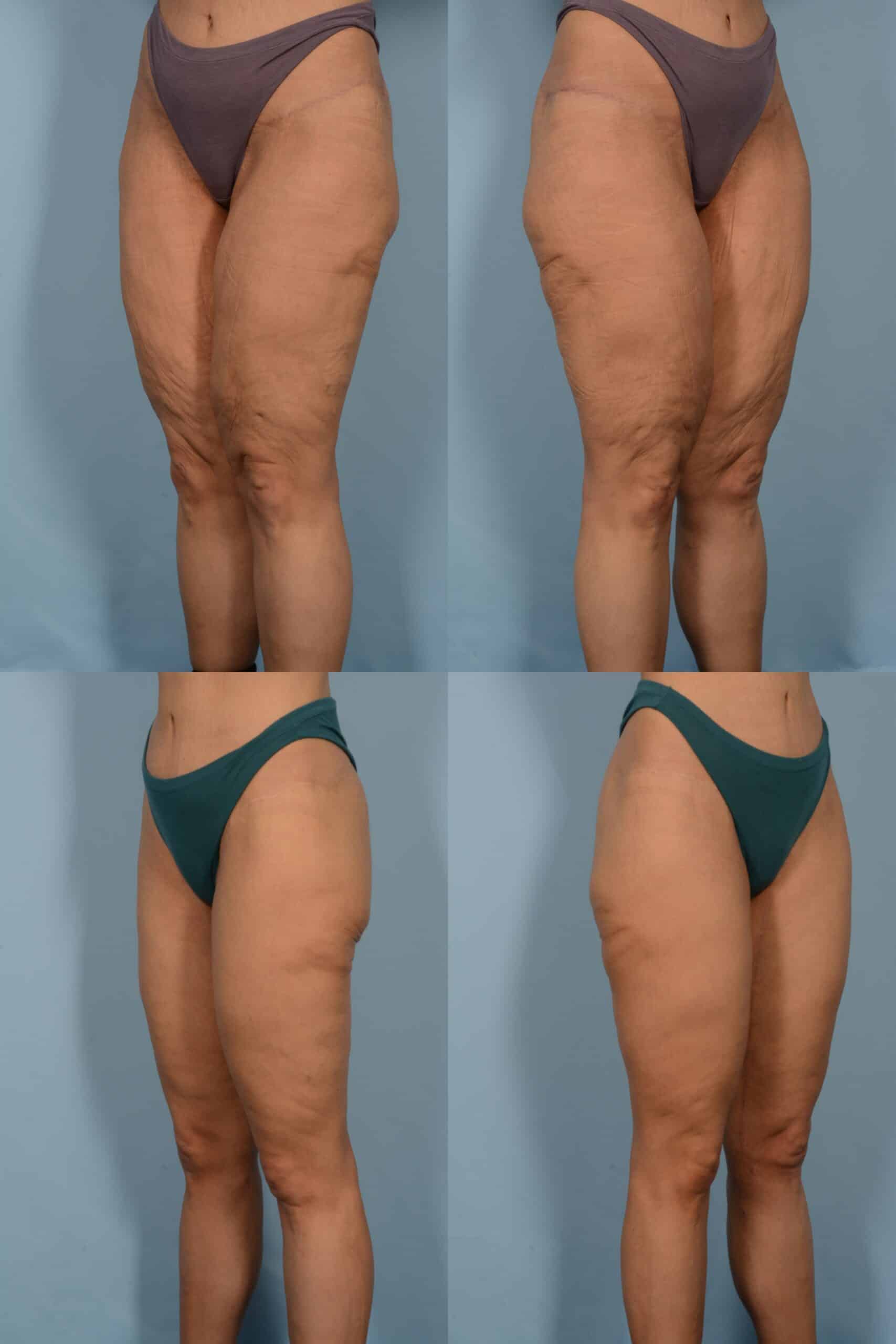 Thigh Lift Case# 1138 Combined Image