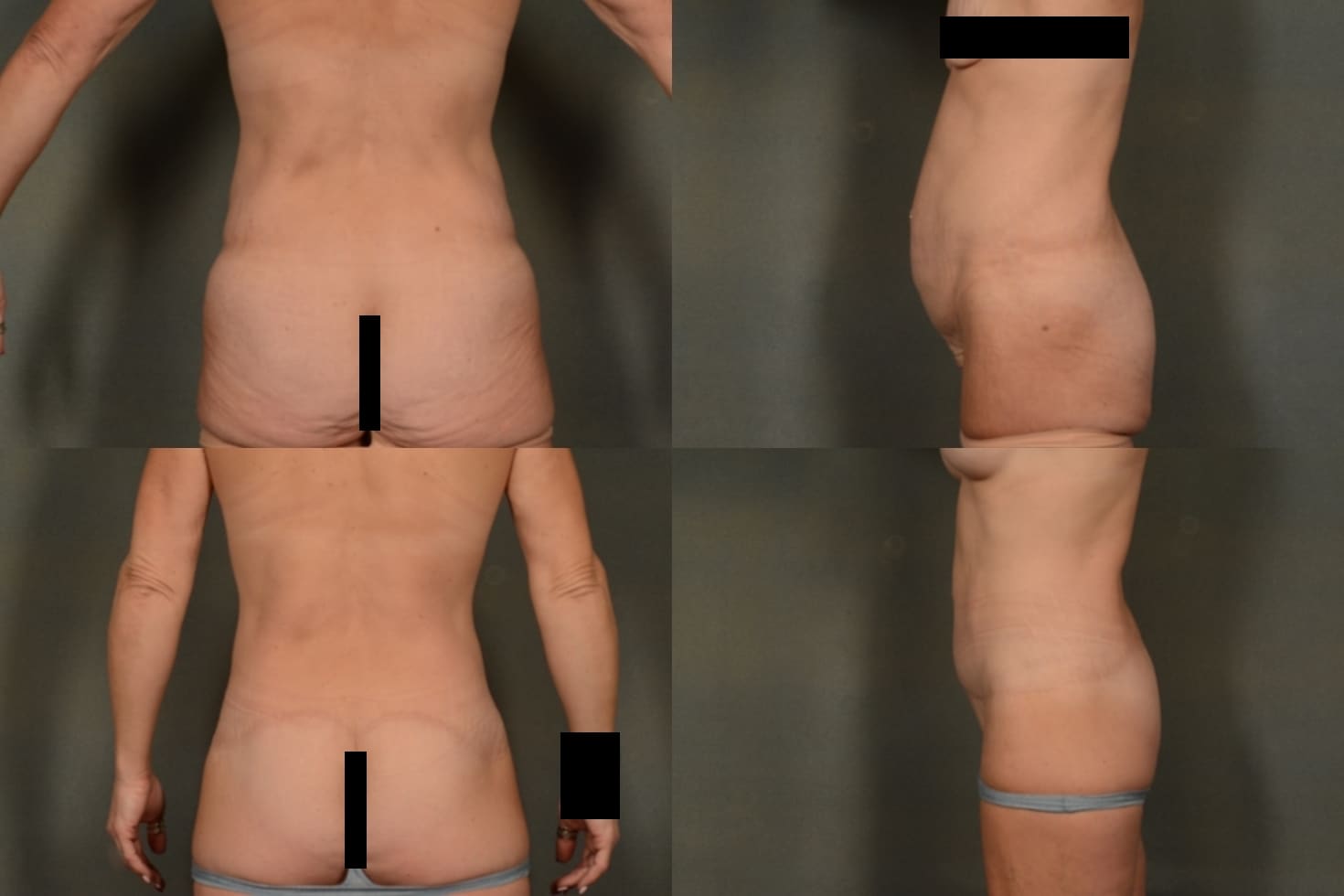 Back Lift Case# 1013 Combined Image