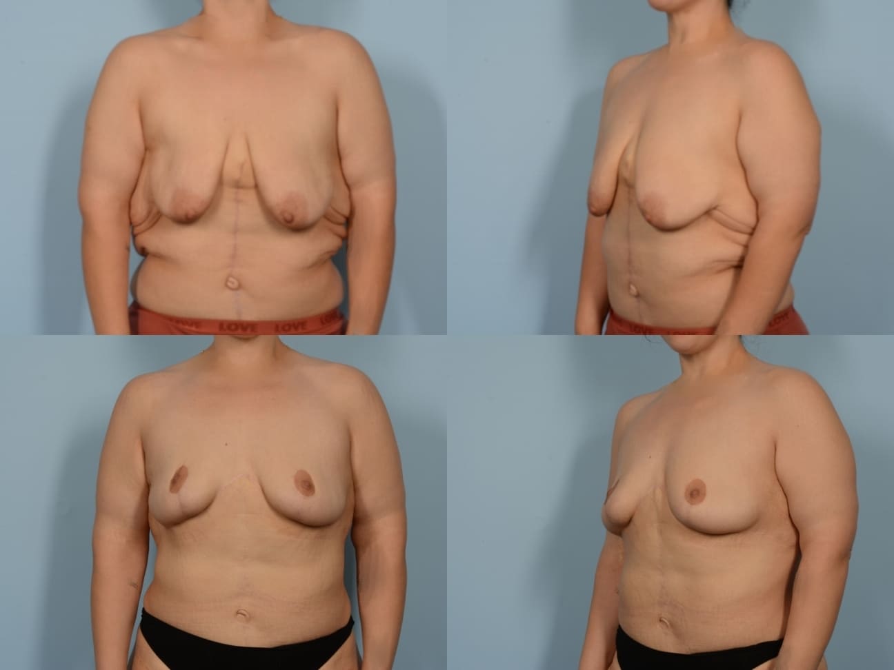 Breast Lift Case# 1181 Combined Image