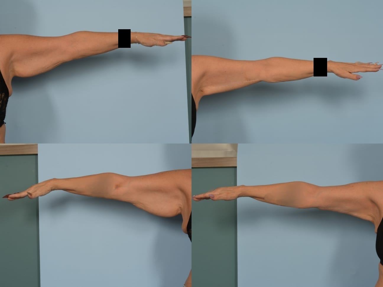 Arm Lift Case# 1192 Combined Image