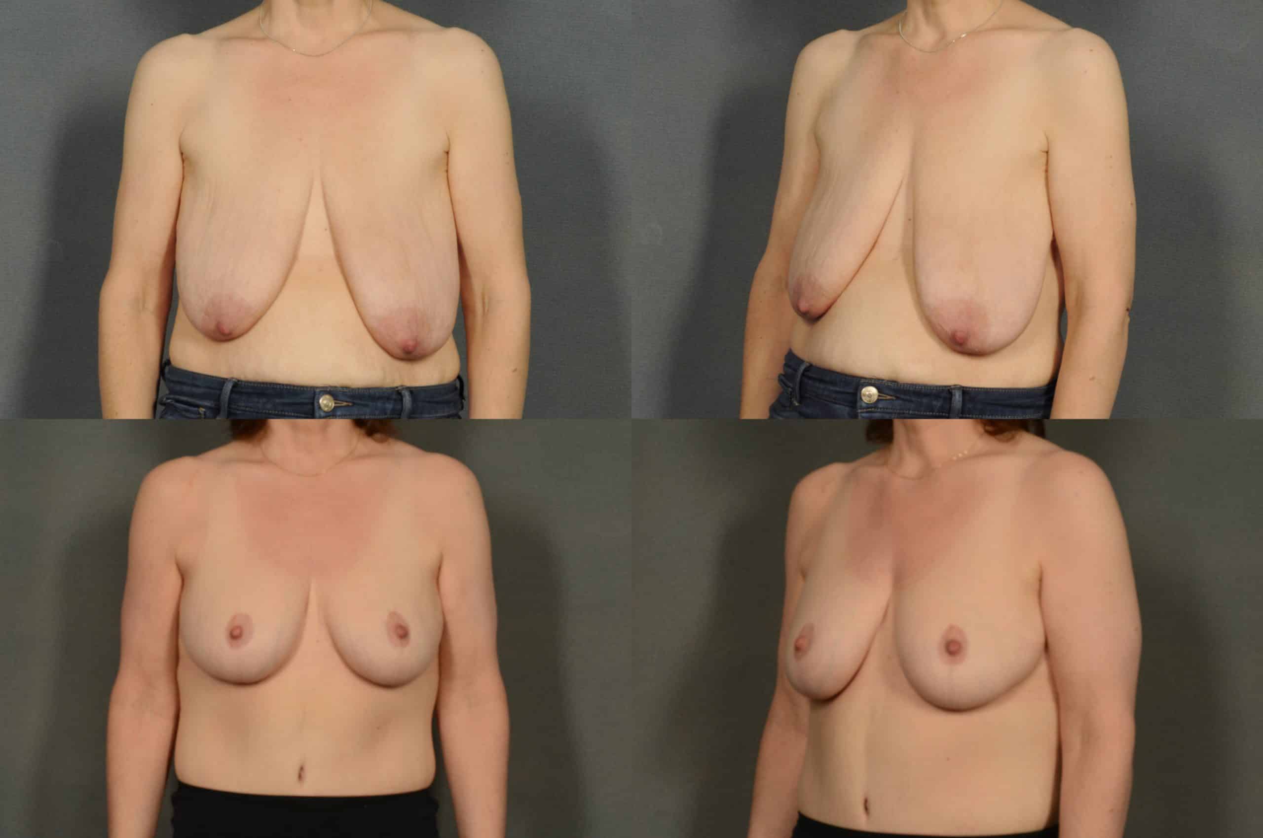Breast Lift with Augmentation Case# 963 Combined Image