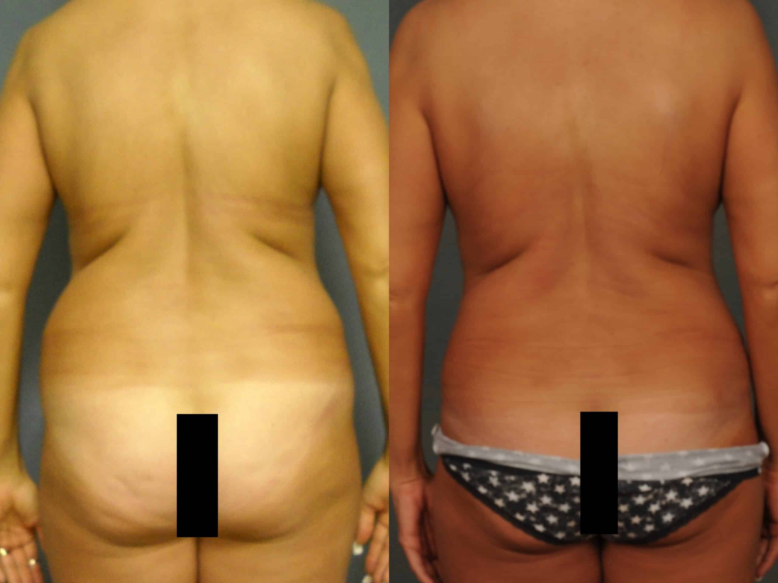 Liposuction Case# 1072 Combined Image