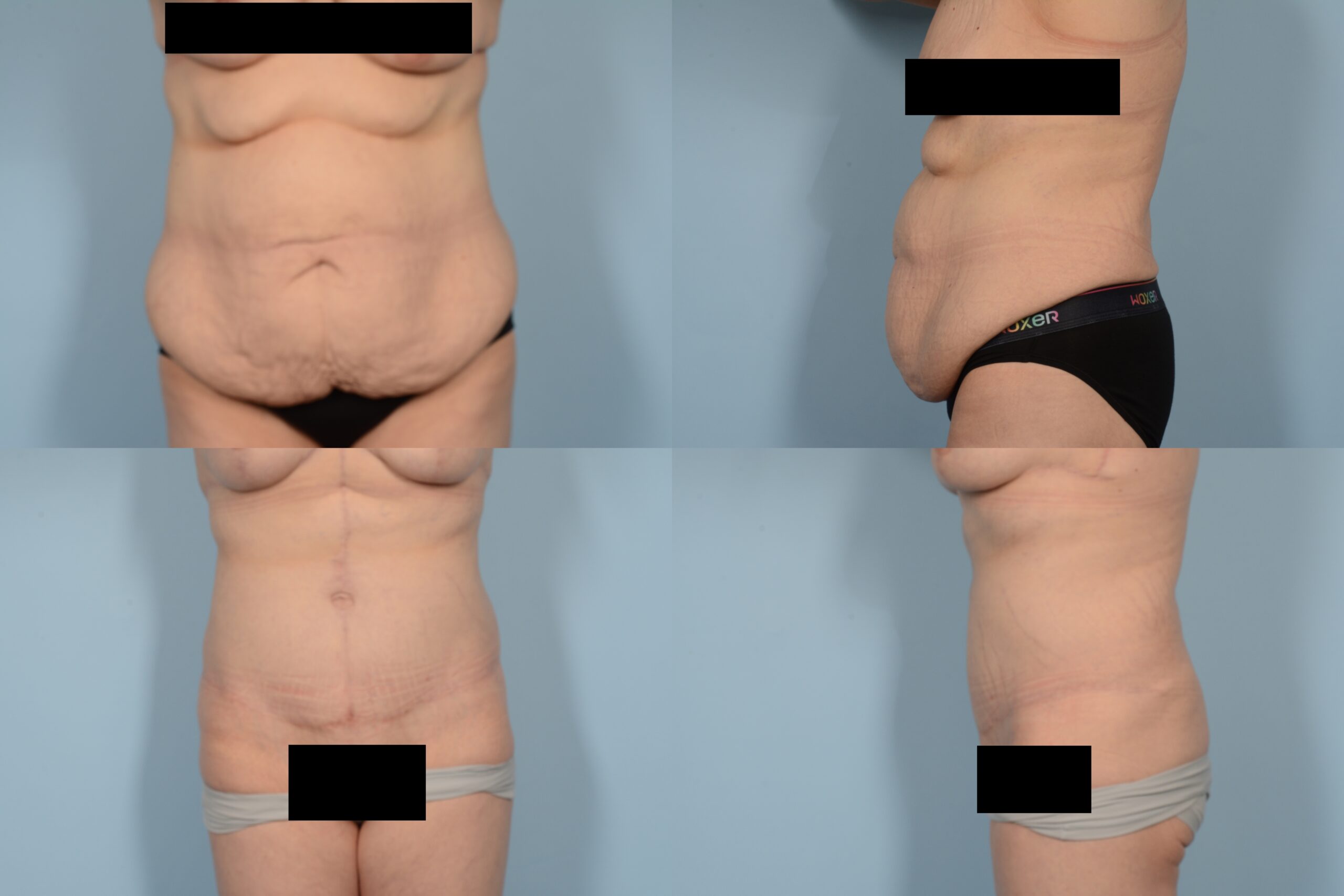 Tummy Tuck Case# 1145 Combined Image