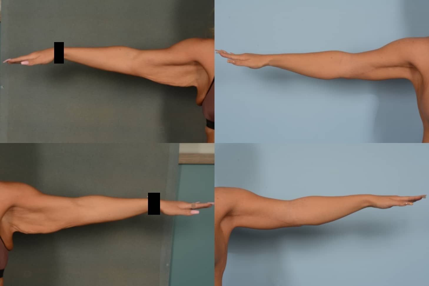 Arm Lift Case# 1130 Combined Image