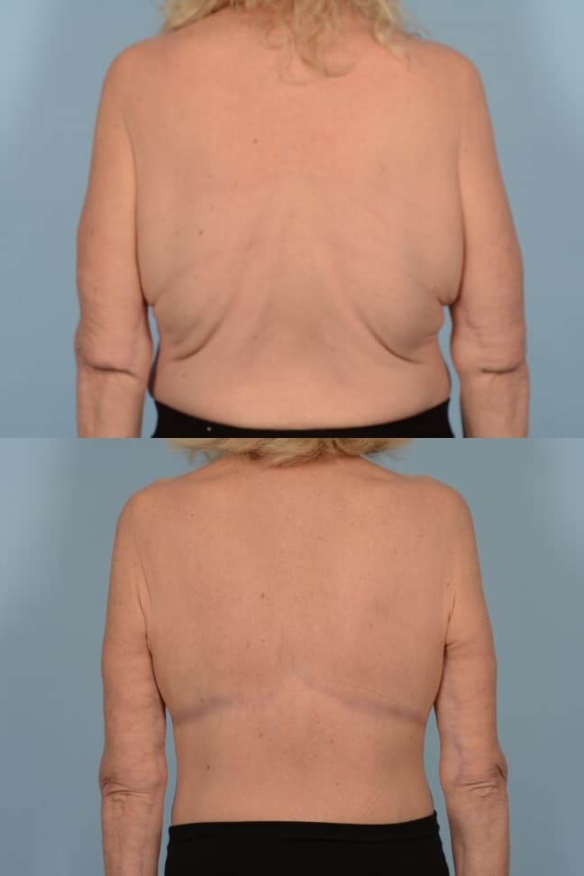 Back Lift Case# 1111 Combined Image