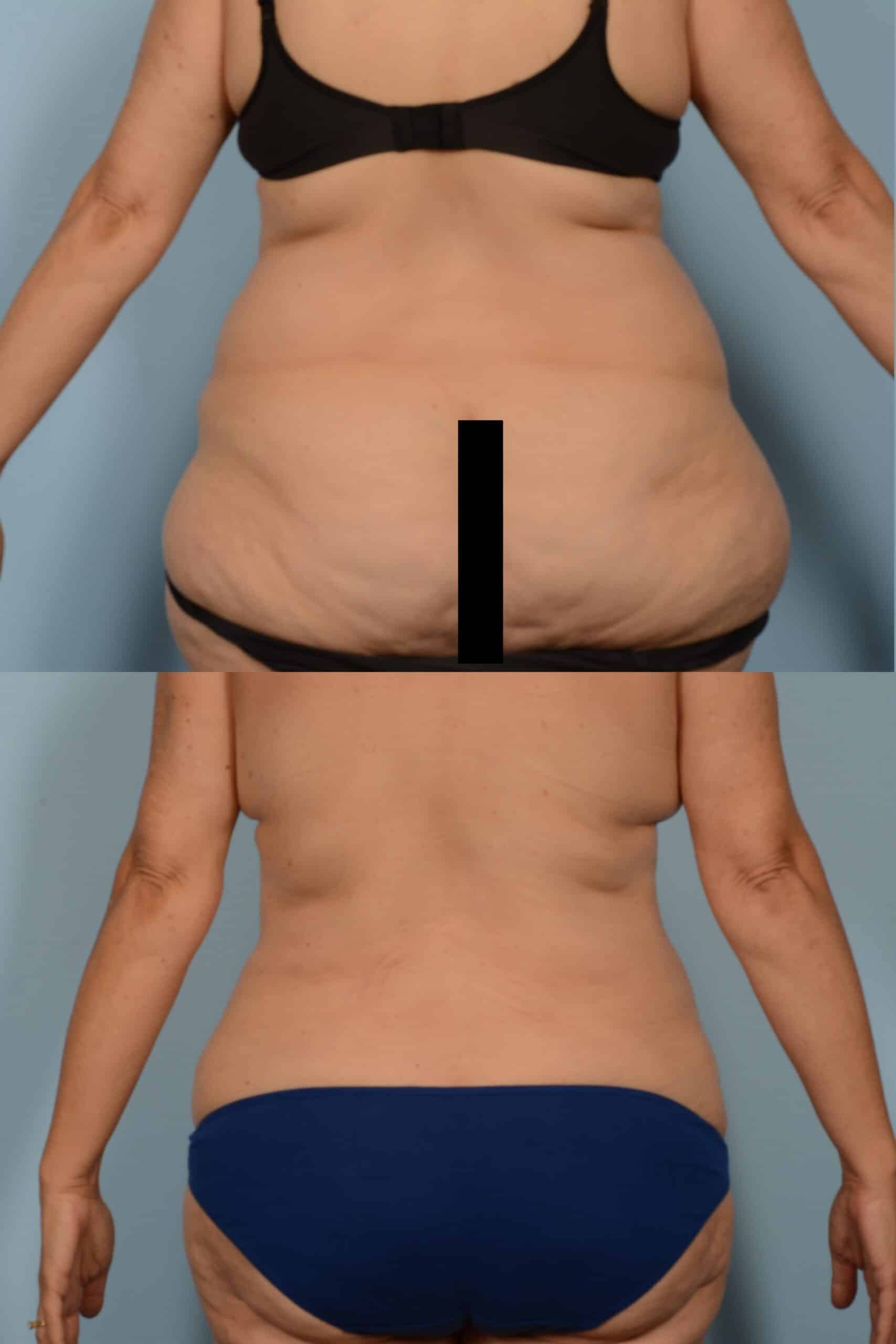 Liposuction Case# 1158 Combined Image