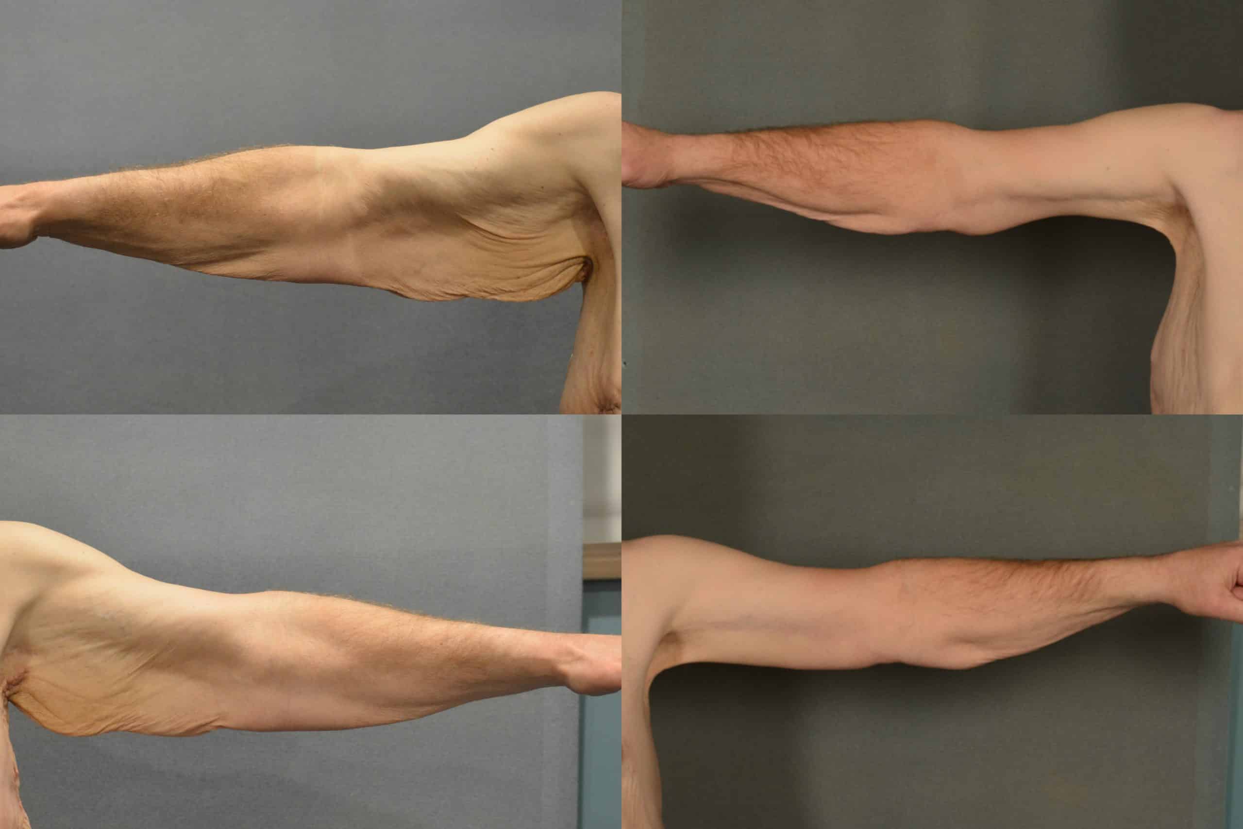 Arm Lift Case# 985 Combined Image