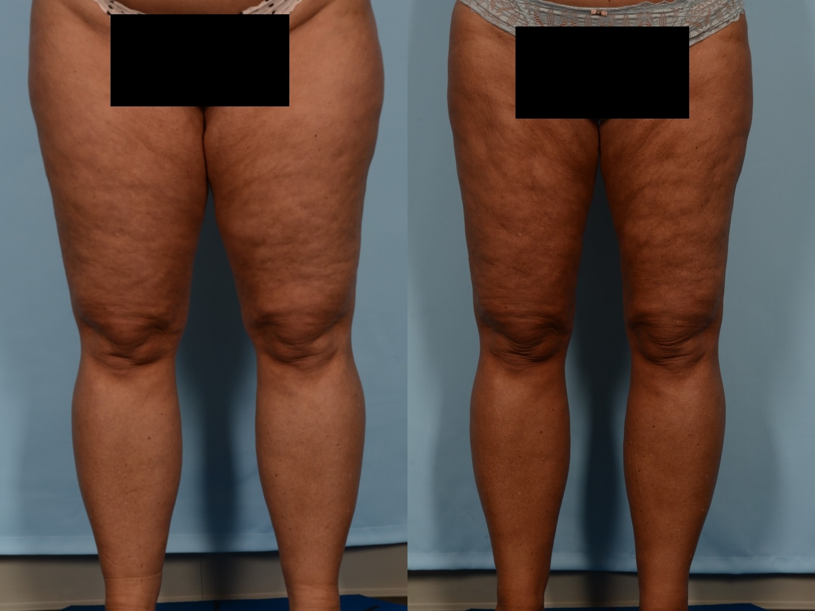 Liposuction Case# 1162 Combined Image
