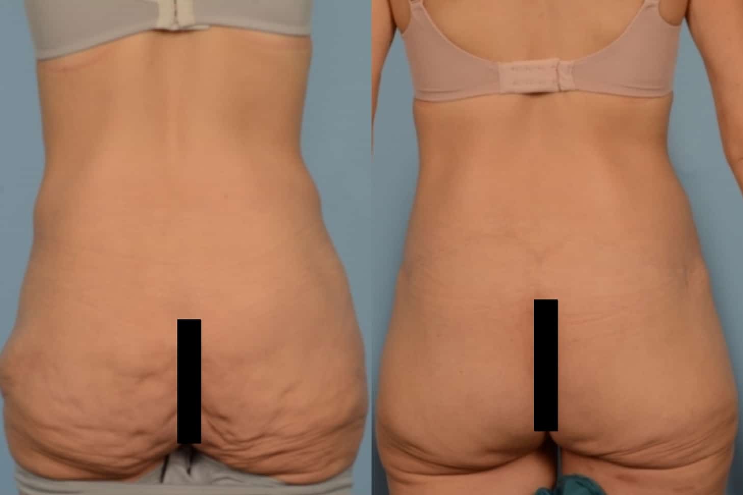 Back Lift Case# 1136 Combined Image