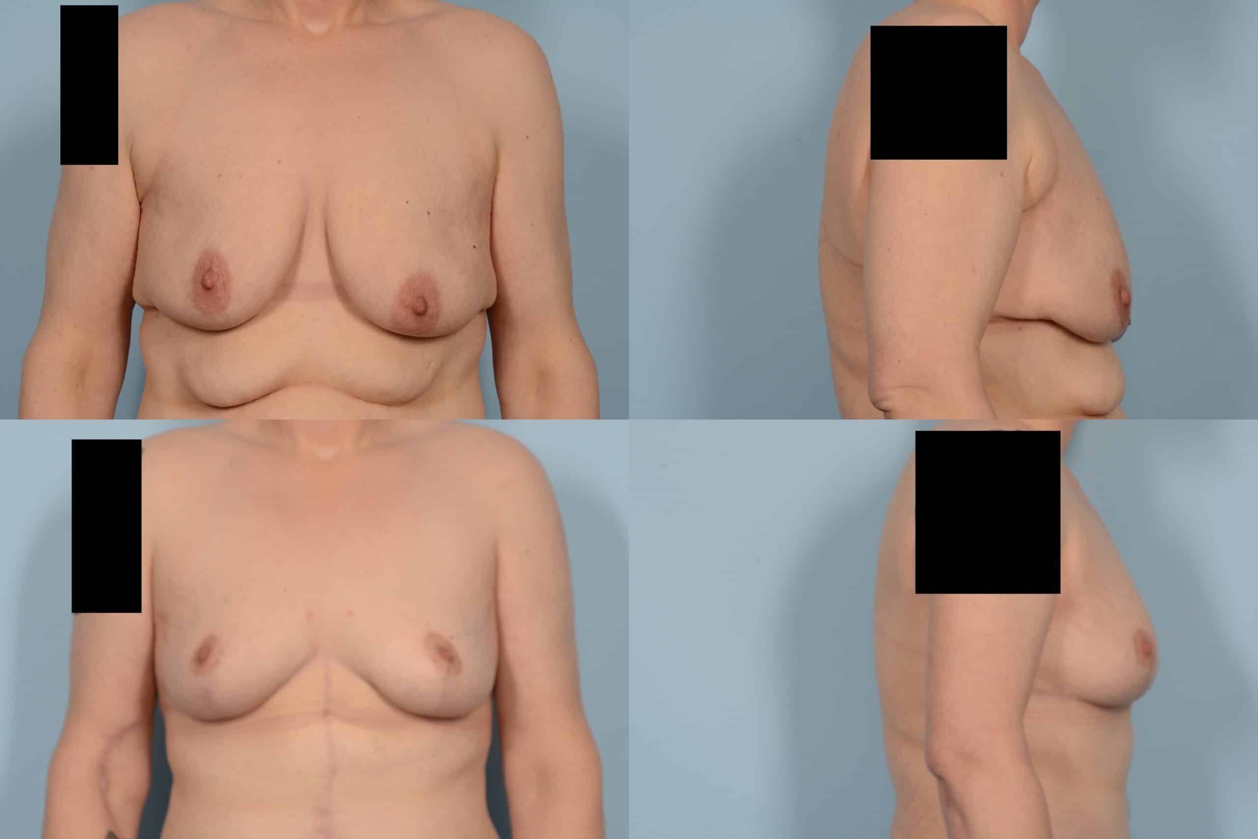 Breast Lift Case# 1144 Combined Image