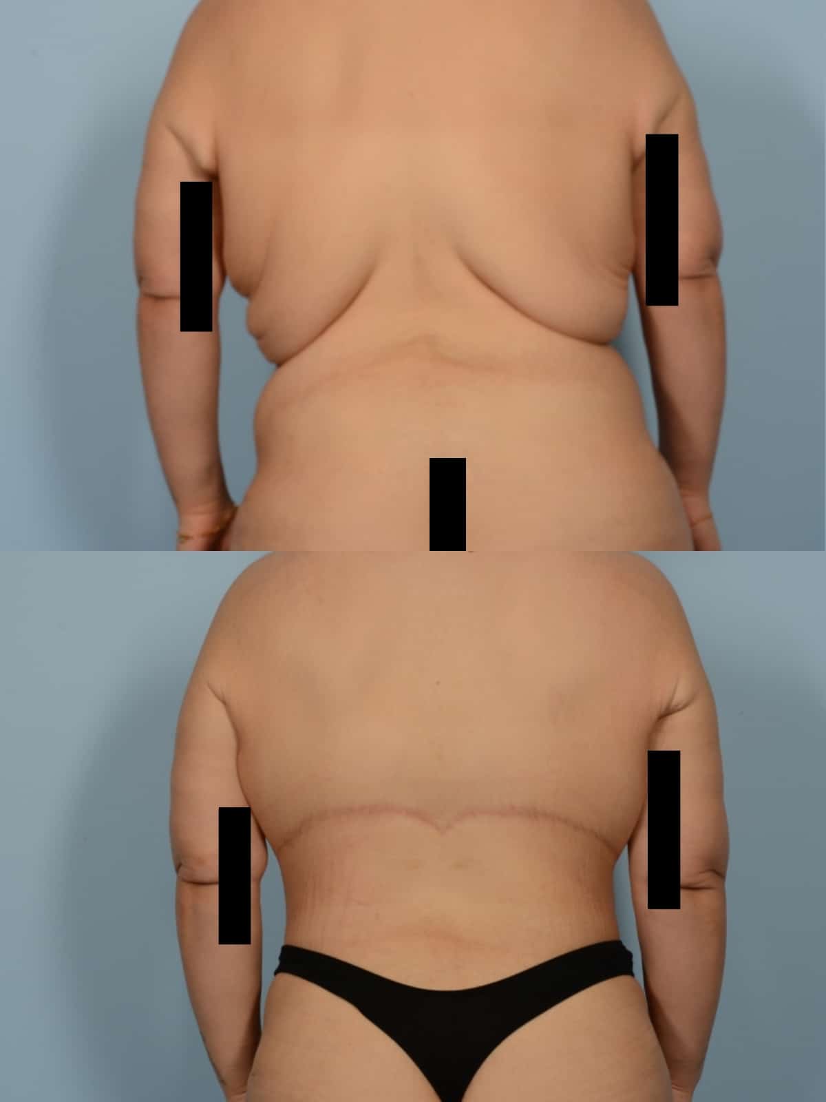 Back Lift Case# 1183 Combined Image