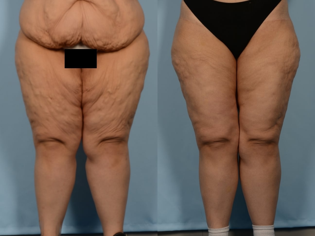 Thigh Lift Case# 1184 Combined Image