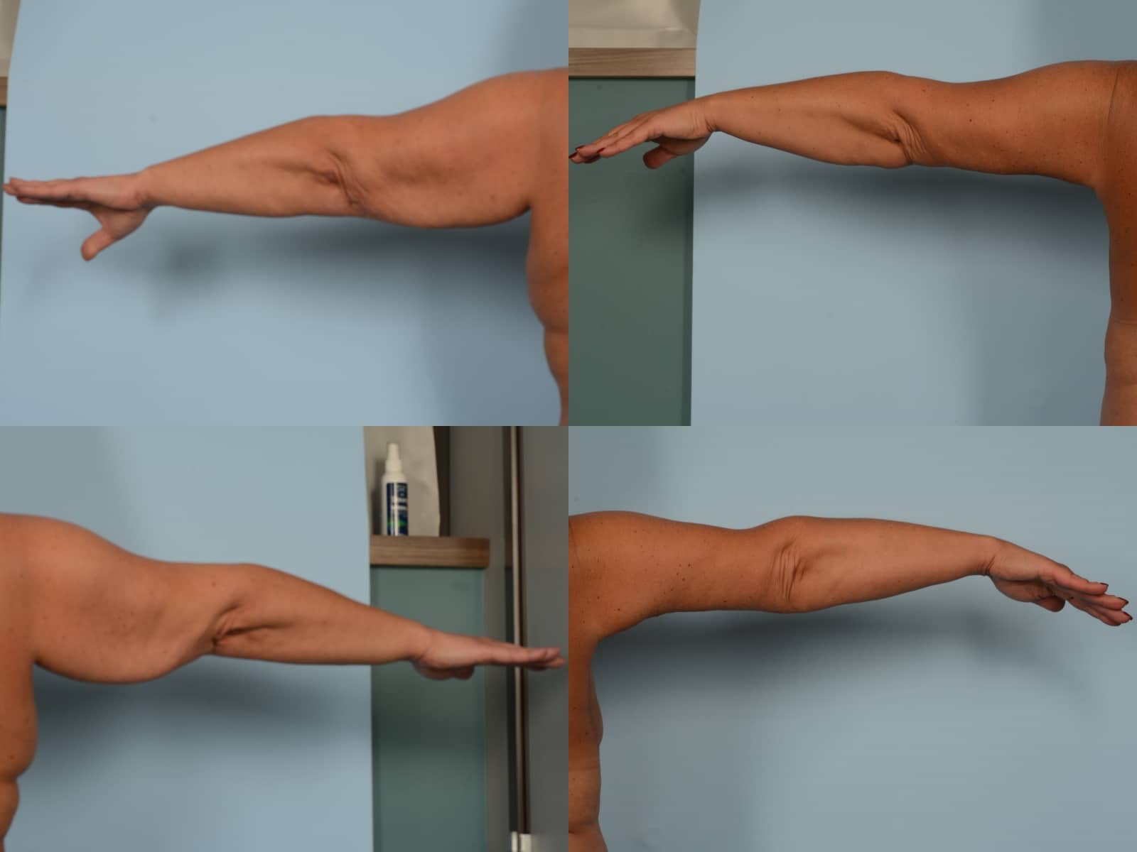 Arm Lift Case# 1163 Combined Image