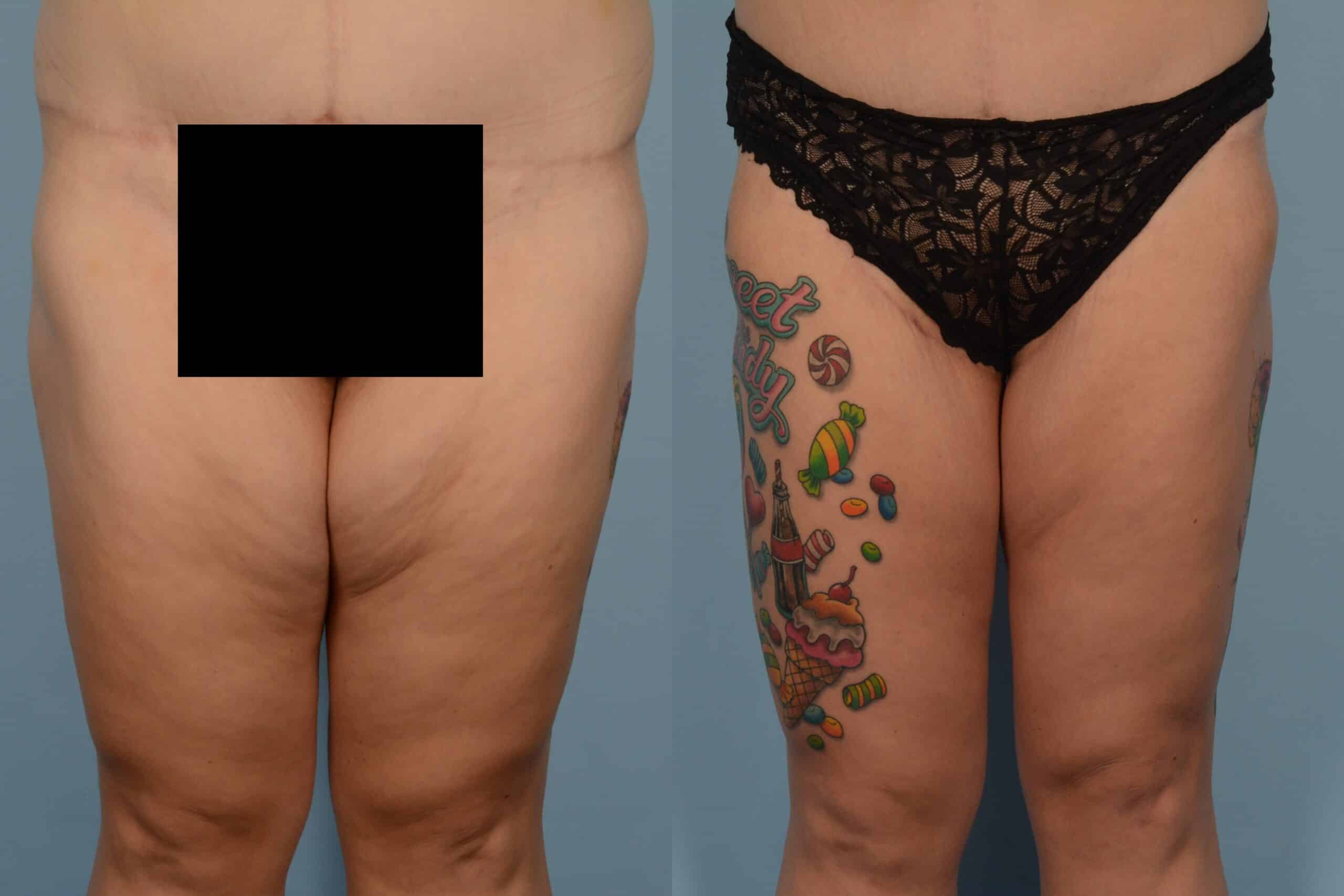 Thigh Lift Case# 1197 Combined Image