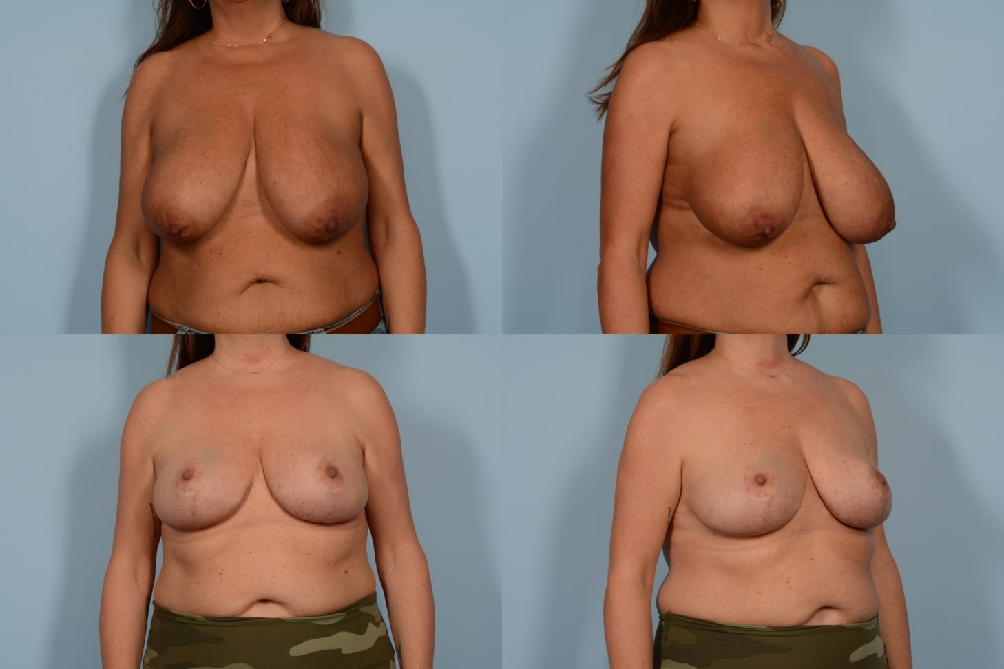 Breast Reduction Case# 1146 Combined Image