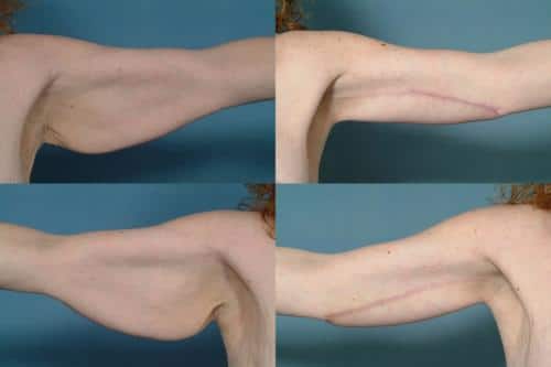 Arm Lift Case #111 Combined Image