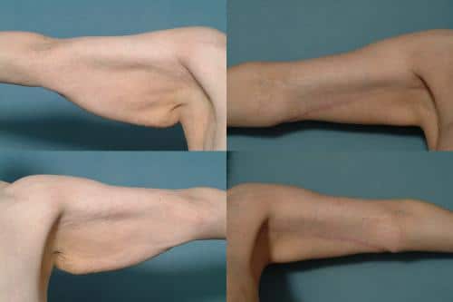 Arm Lift Case #112 Combined Image