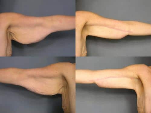 Arm Lift Case #155 Combined Image
