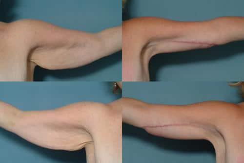 Arm Lift Case #156 Combined Image