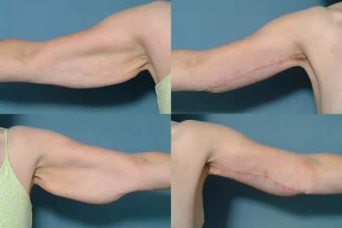 Arm Lift Case #157 Combined Image