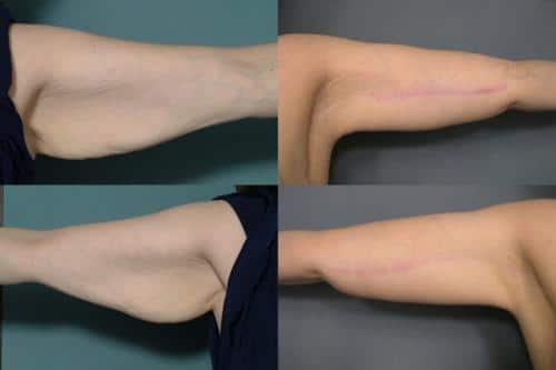 Arm Lift Case #158 Combined Image