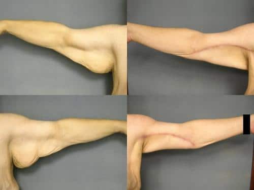 Arm Lift Case #239 Combined Image