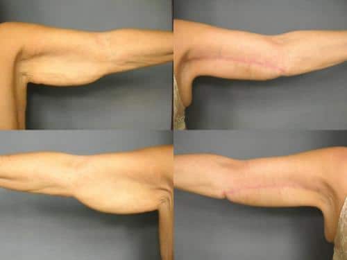 Arm Lift Case #244 Combined Image