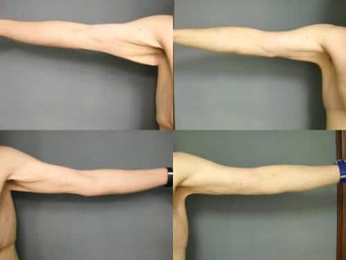 Arm Lift Case #257 Combined Image